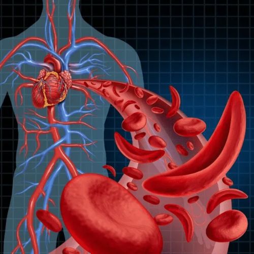 Anemia