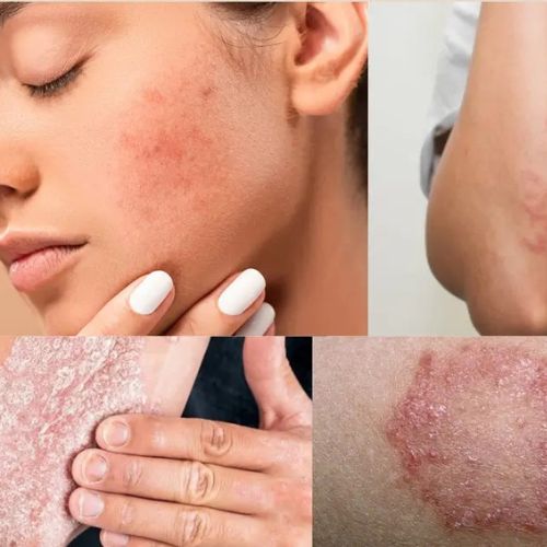 Treatment of Skin Diseases